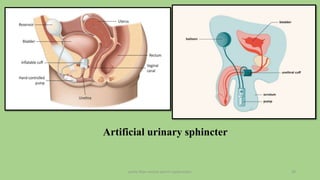 pelvic floor muscle and it's dysfunction 20
Artificial urinary sphincter
 