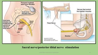 pelvic floor muscle and it's dysfunction 21
Sacral nerve/posterior tibial nerve stimulation
 
