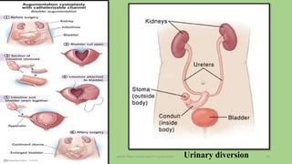 pelvic floor muscle and it's dysfunction 22
Urinary diversion
 