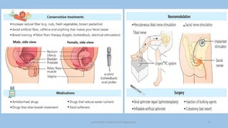 pelvic floor muscle and it's dysfunction 27
 