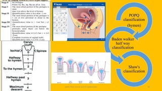 pelvic floor muscle and it's dysfunction 36
POPQ
classification
(hymen)
Baden walker
half way
classification
Shaw's
classification
 