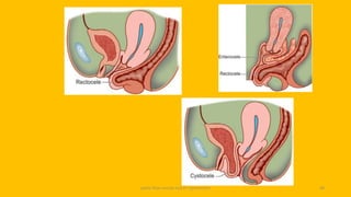 pelvic floor muscle and it's dysfunction 38
 