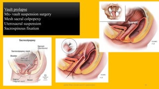 pelvic floor muscle and it's dysfunction 41
Vault prolapse
Mx- vault suspension surgery
Mesh sacral colpopexy
Uterosacral suspension
Sacrospinous fixation
 