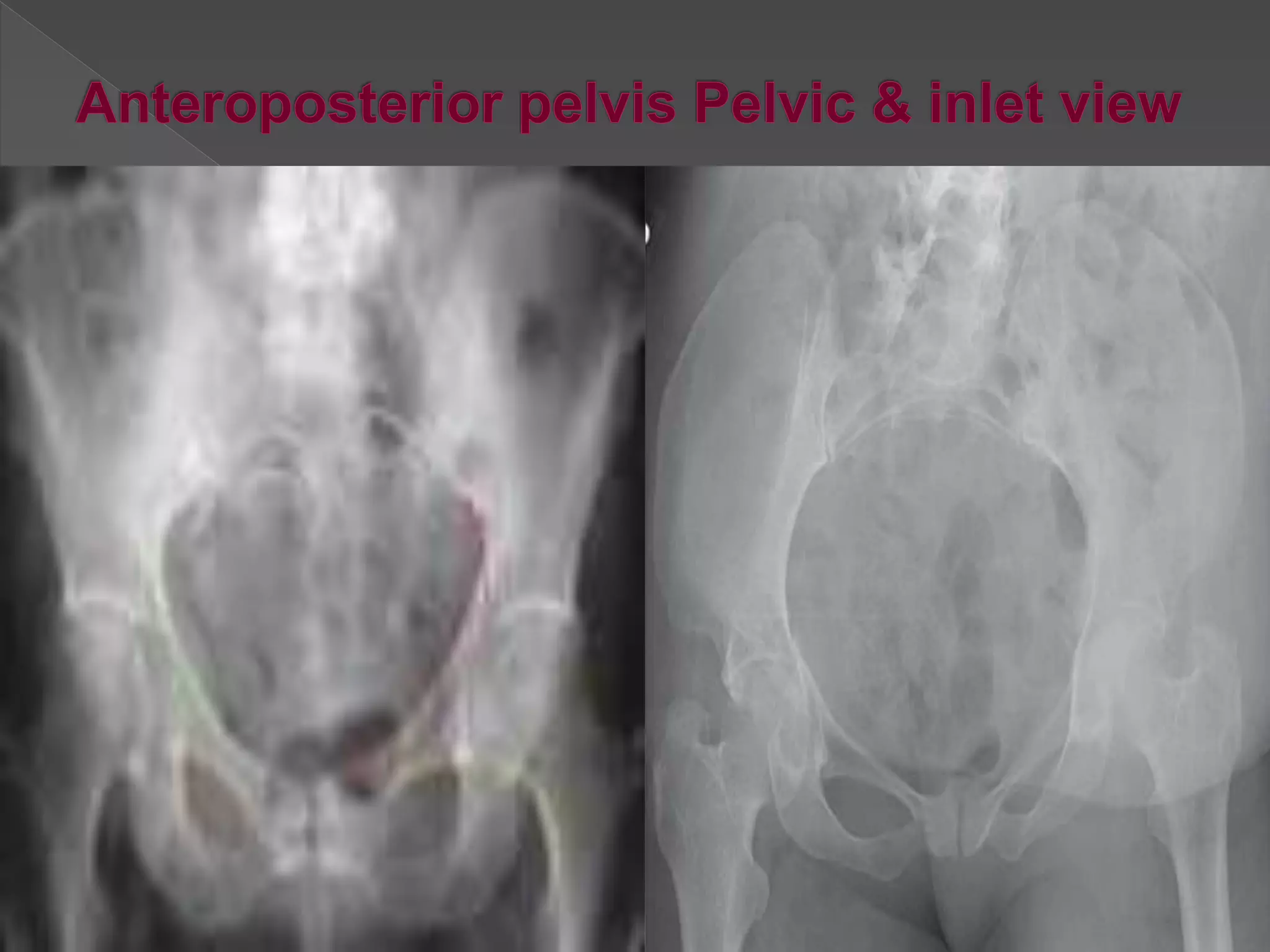 Pelvic fracture