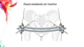 Pelvic Fracture | PPTX
