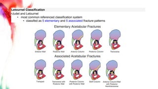 Jude Letournel Classification Pelvic Fracture | PPTX