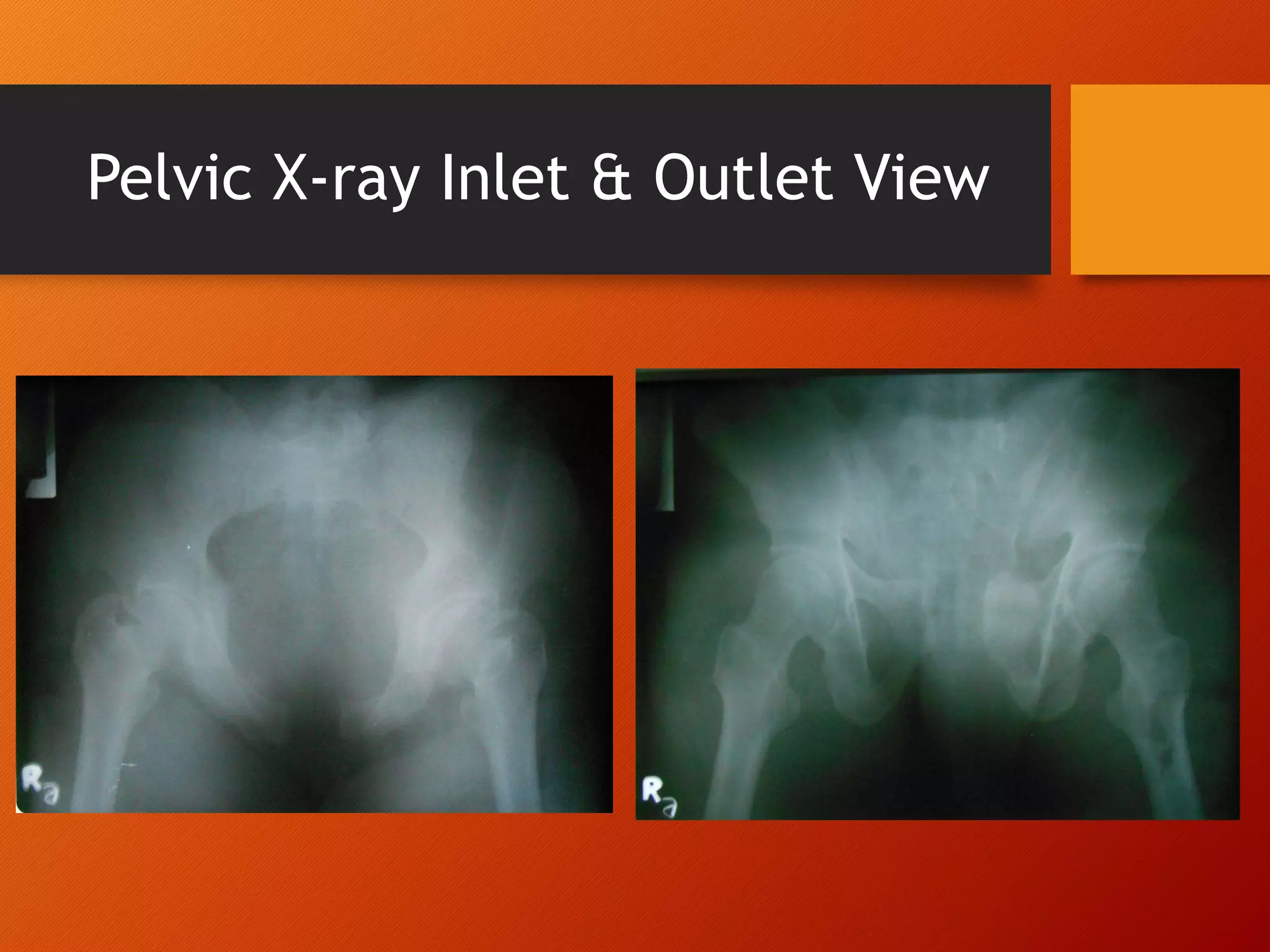 - Pelvic Fracture.pptx
