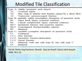 Modified Tile Classification
Tile M: Pelvic ring fractures: Should they be fixed? J Bone Joint Surg Br
1988; 70:1-12.
 