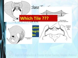 Tile classification
• Modification of Pennal Idea
• Tile et al added the concept of stability
The Tile classification syst...