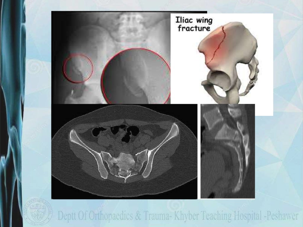 Hip Pelvic Fracture