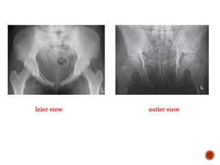 PELVIC FRACTURE by Dr.Sarvesh Yadav.pptx