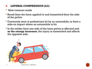 Lateral Compression Text PELVIC FRACTURE by Dr.Sarvesh Yadav.pptx