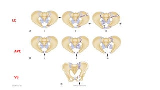 LC
APC
VS
2018/01/16 Pelvic Fractures
 