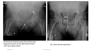 2018/01/16 Pelvic Fractures
widening of symphysis pubis & sacroiliac joint.
displaced fracture of the right femoral shaft .
APC injury (open book)
S/P pelvic binder application
 