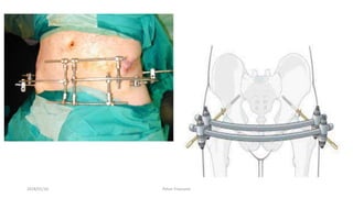 2018/01/16 Pelvic Fractures
 