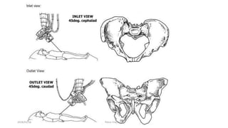 2018/01/16 Pelvic Fractures
 
