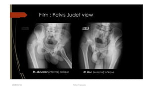 2018/01/16 Pelvic Fractures
 