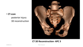 • CT-scan
posterior injury
3D reconstruction
CT 3D Reconstruction- APC 3
2018/01/16 Pelvic Fractures
 