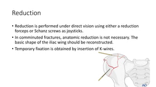 pelvic fractures.pptx