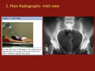 Pelvic fractures and Physiotherapy | PPTX