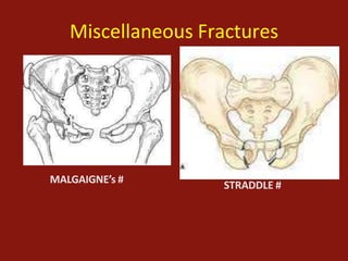 Pelvic fractures and Physiotherapy | PPT