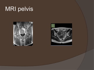 MRI pelvis
 