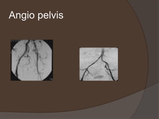 Angio pelvis
 