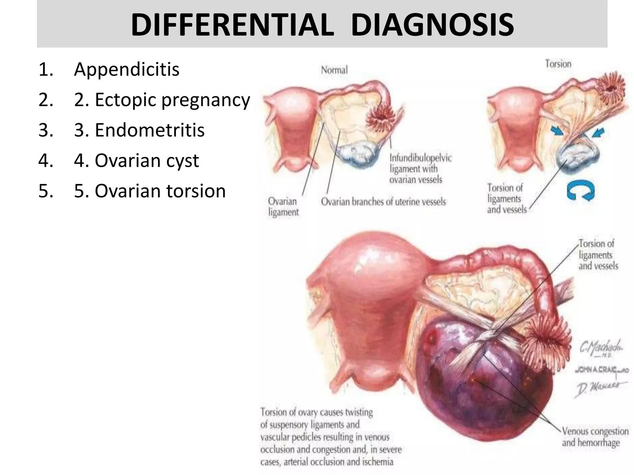 Pelvic inflammatory diaease | PPTX