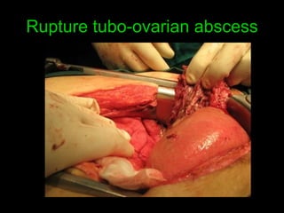 Rupture tubo-ovarian abscess 
