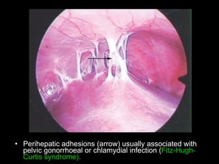 Perihepatic adhesions  ( arrow )  usually associated with pelvic gonorrhoeal or chlamydial infection  ( Fitz - Hugh - Curtis syndrome ). 