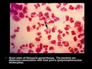 Gram stain of  Neisseria gonorrhoeae,   The bacteria are diplococci association with host pmn's  ( polymorphonuclear leukocytes ).  