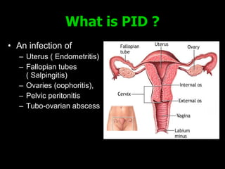 What is PID  ? An  infection of  U terus  ( Endometritis) F allopian tubes  ( Salpingitis) O varies (oophoritis),  Pelvic peritonitis Tubo-ovarian abscess 