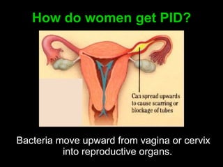 How do women get PI D? B acteria move upward from vagina or cervix into reproductive organs. 
