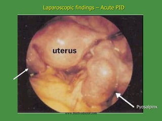 Laparoscopic findings – Acute PID Pyosalpinx www.freelivedoctor.com 