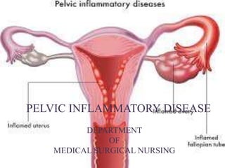 PELVIC INFLAMMATORY DISEASE
DEPARTMENT
OF
MEDICAL SURGICAL NURSING
 