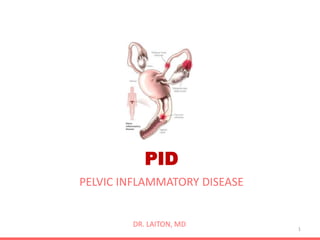 PID
PELVIC INFLAMMATORY DISEASE
1
DR. LAITON, MD
 
