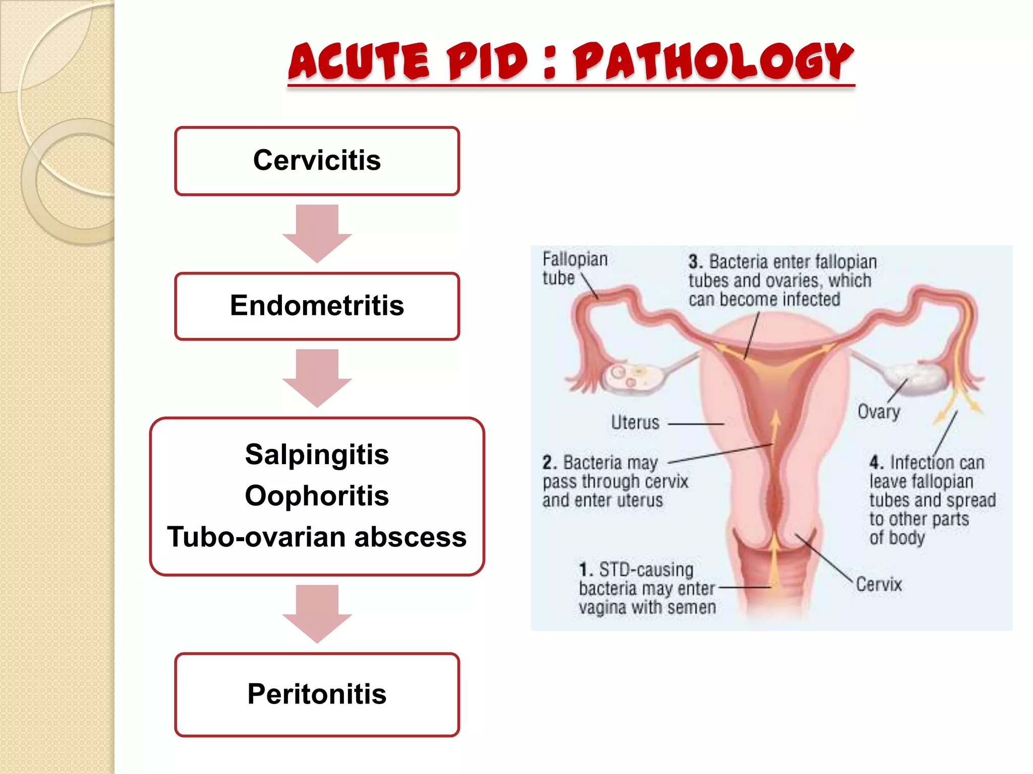 Pelvic Inflammatory Disease PPTX Pelvic Inflammatory Disease PPTX