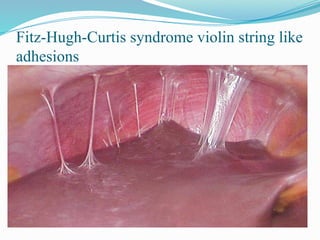 String. Sign Fitz PELVIC INFLAMMATORY DISEASE PRESENTATION.pptx