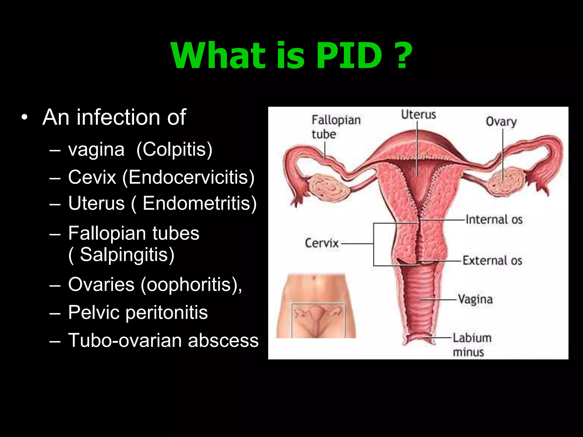 Pelvic inflammatory diseases | PPTX