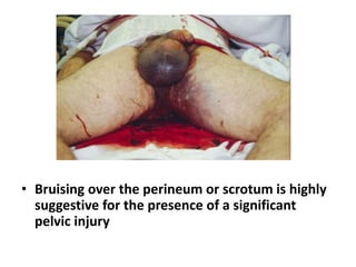 • Bruising over the perineum or scrotum is highly
suggestive for the presence of a significant
pelvic injury
 