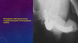 Retrograde Urethrogram Rupture Pelvic injuries and associated injuries | PPTX