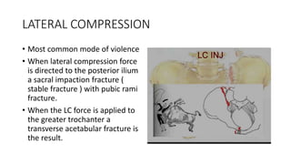 Lateral Compression Text Pelvic injuries | PPTX
