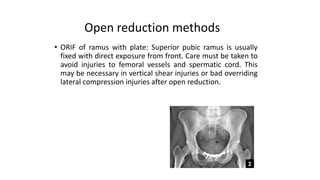 Pelvic injuries | PPTX