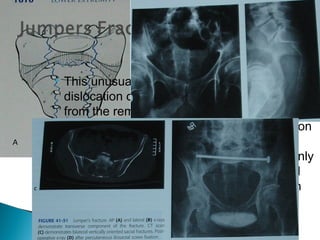  This unusual fracture is represented by
dislocation of central portion of upper sacrum
from the remainder of pelvic ring. There is
bilateral vertical sacral fracture in association
with transverse fracture (H-shaped) a
characteristic of this injury. This is commonly
seen in “suicide jumpers”. Neurological
injury to the sacral nerve root is common in
this type
 
