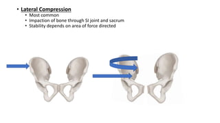 Lateral Compression Text Pelvic injuries for MBBS (undergraduate medical education) | PPTX