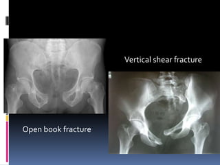 Open book fracture 
Vertical shear fracture 
 