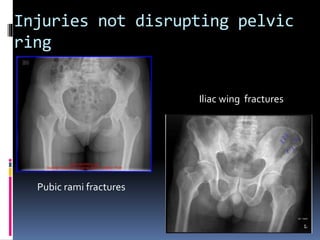 Injuries not disrupting pelvic 
ring 
Pubic rami fractures 
Iliac wing fractures 
 