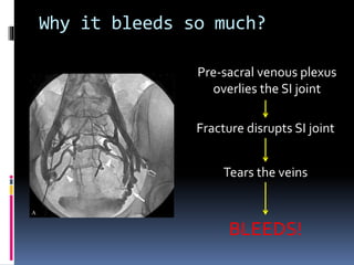 Why it bleeds so much? 
Pre-sacral venous plexus 
overlies the SI joint 
Fracture disrupts SI joint 
Tears the veins 
BLEEDS! 
 