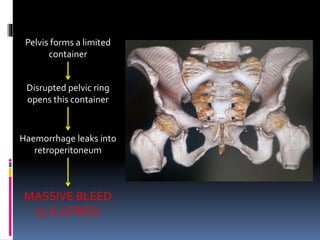 Pelvis forms a limited 
container 
Disrupted pelvic ring 
opens this container 
Haemorrhage leaks into 
retroperitoneum 
MASSIVE BLEED 
(5-6 LITRES) 
 
