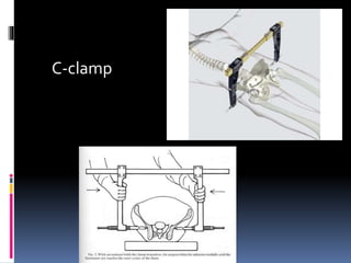 C-clamp 
 